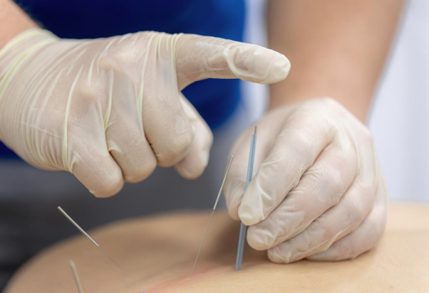 What Are the Benefits of Visiting Experienced Needling Acupuncturists for Chronic Pain?